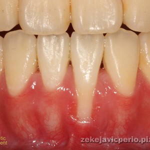 牙根覆蓋術牙齦增厚 雅偲牙醫