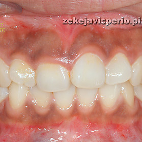 水雷射 牙齦黑色素 雅偲牙醫