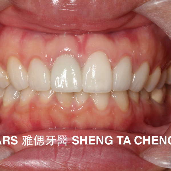 水雷射牙齦整形+全瓷冠+陶瓷貼片+微笑曲線案例 (1032) 牙冠增長術