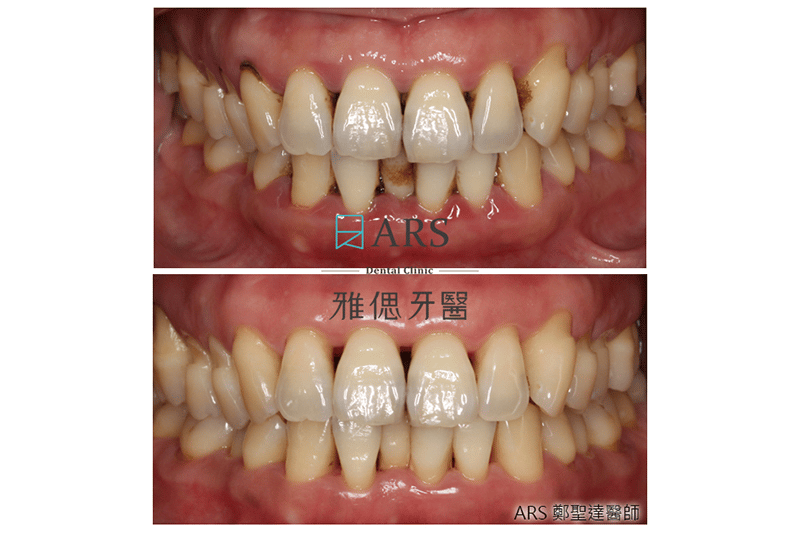 水雷射牙周治療前後