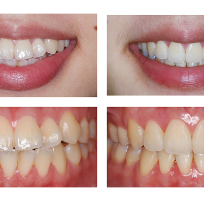 隱形矯正 排整齊