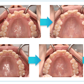 隱形矯正 成人矯正 暴牙 牙齒排列不整 隱形矯正 成人矯正 暴牙 牙齒排列不整