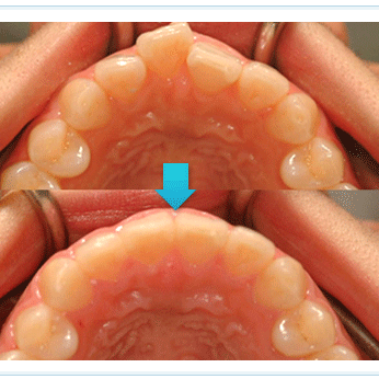 隱形矯正 成人矯正 案例 牙齒排列不整 隱形矯正 成人矯正 案例 牙齒排列不整