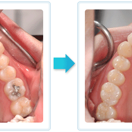 隱形矯正 排齊 牙齒擁擠1
