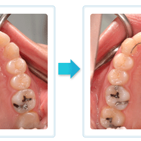 隱形矯正 暴牙排齊