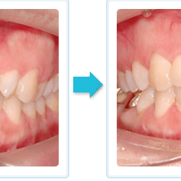 隱形矯正 深咬案例 成人矯正 深咬排齊 隱形矯正 深咬案例 成人矯正 深咬排齊 宜可麗