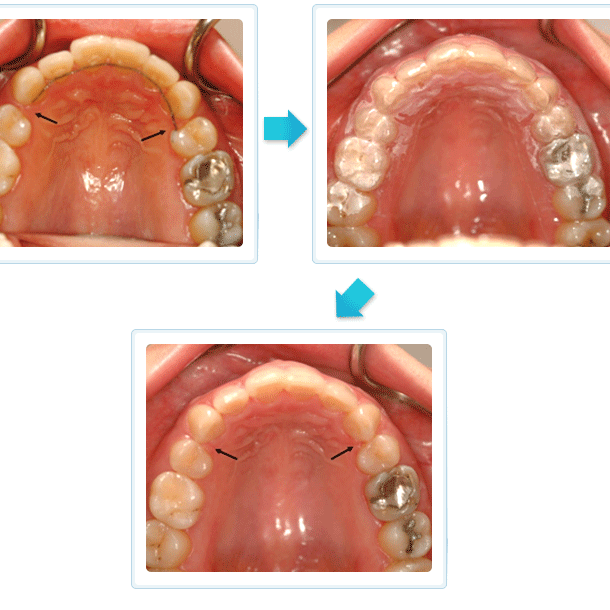 隱形矯正 矯正移位後 再治療 宜可麗案例 隱形矯正 矯正移位後 再治療 宜可麗案例