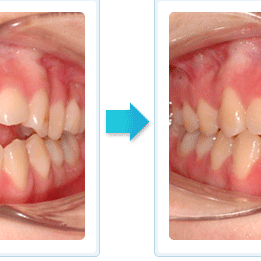 隱形矯正 開咬 open bite 矯正案例 隱形矯正 開咬 open bite 矯正案例