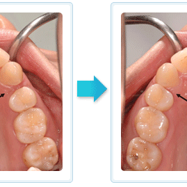 隱形矯正 關縫 牙縫太開 成人矯正案例 隱形矯正 關縫 牙縫太開 成人矯正案例