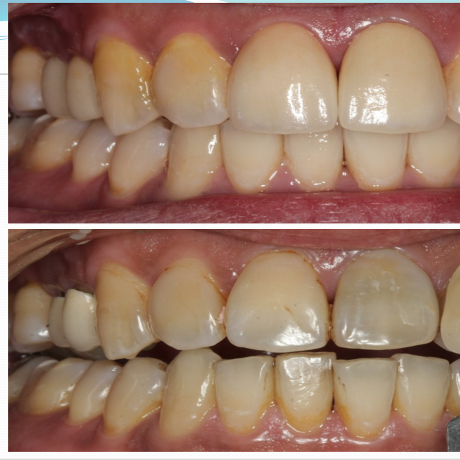 全瓷冠 鄭聖達醫師