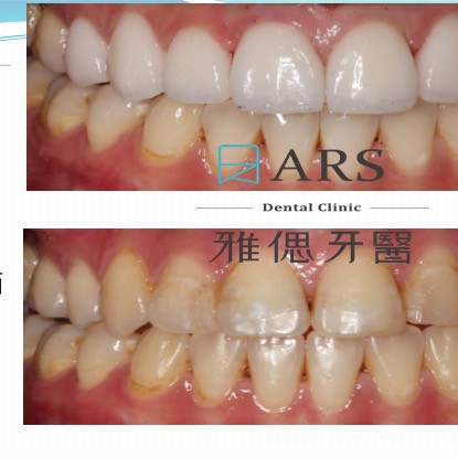 全瓷冠 02 Dr. Tsai