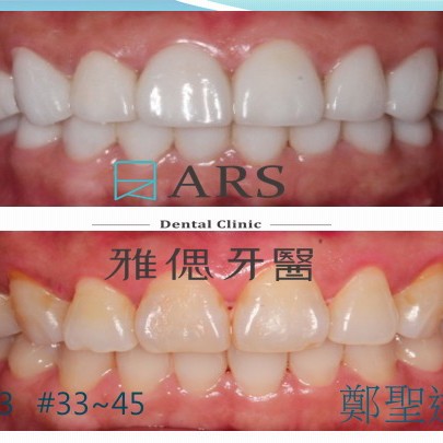 陶瓷貼片 案例2 鄭聖達醫師
