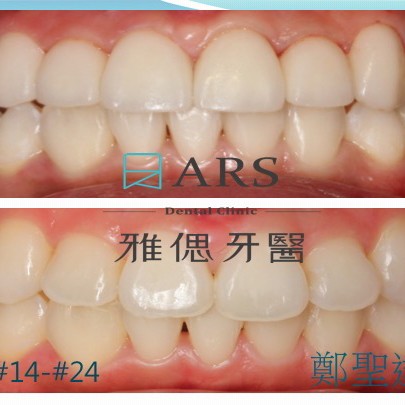全瓷冠+陶瓷貼片 案例3 鄭聖達醫師