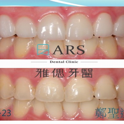 全瓷冠+陶瓷貼片 案例4 鄭聖達醫師