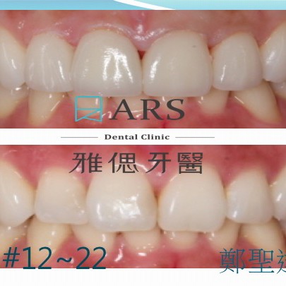 全瓷冠+陶瓷貼片 案例5 鄭聖達醫師