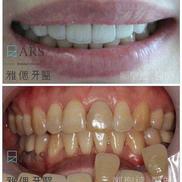 矯正後牙齒黃-陶瓷貼片-推薦案例-鄭聖達醫師-雅偲牙醫-台北