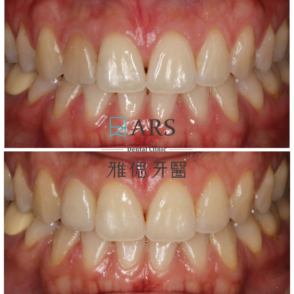 【全瓷冠】 案例1 – 鄭聖達醫師