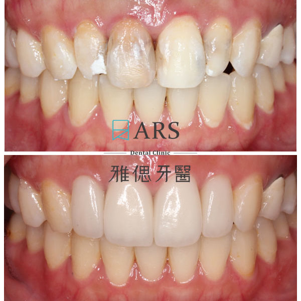 【全瓷冠】 案例1 –蔡昀蓉醫師