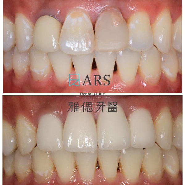 【全瓷冠】 案例10 – 蔡昀蓉醫師