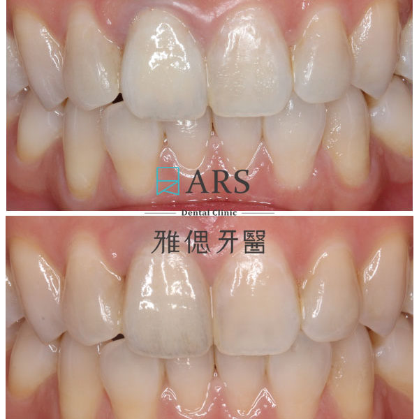 【全瓷冠】 案例11 –蔡昀蓉醫師