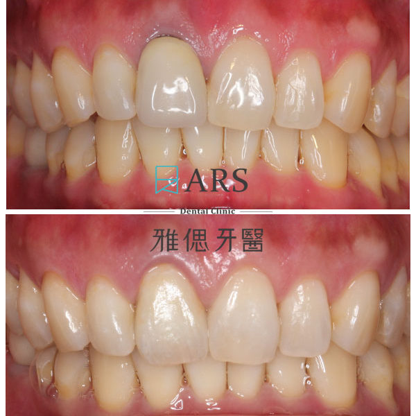 【全瓷冠】 案例12 –蔡昀蓉醫師