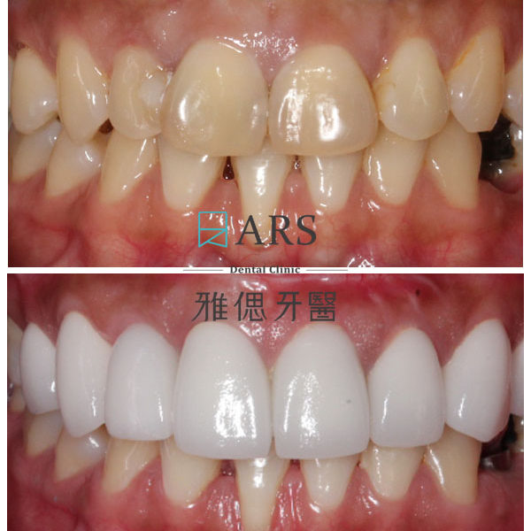 【全瓷冠】 案例2 – 鄭聖達醫師