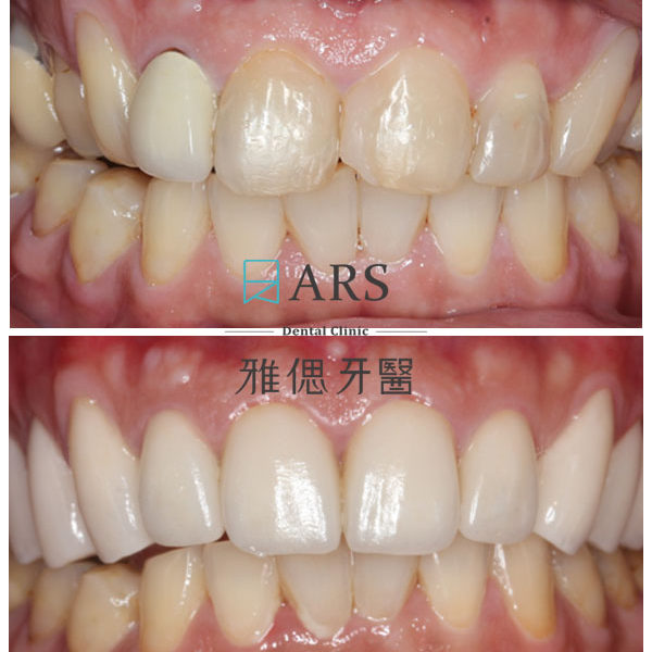 【全瓷冠】 案例2 –蔡昀蓉醫師