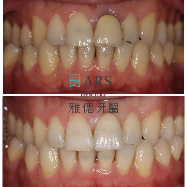 【全瓷冠】 案例3 – 鄭聖達醫師