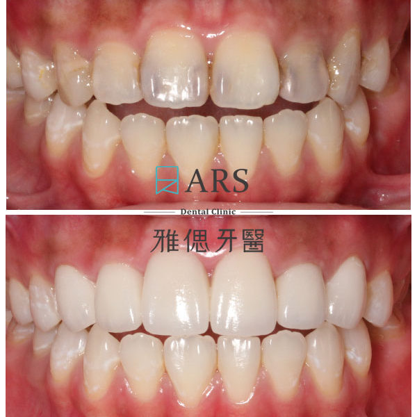 【全瓷冠】 案例3 –蔡昀蓉醫師