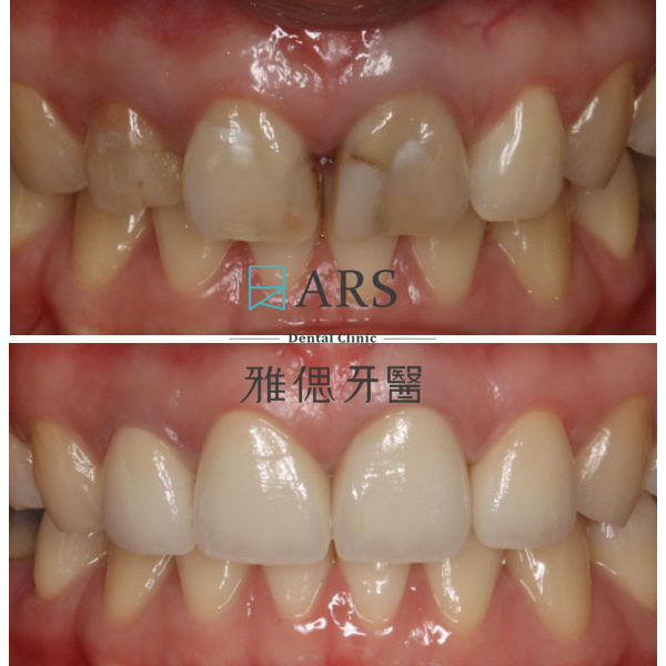 【全瓷冠】 案例4 – 鄭聖達醫師