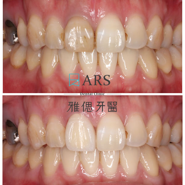 【全瓷冠】 案例4 –蔡昀蓉醫師