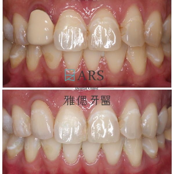 【全瓷冠】 案例5 –蔡昀蓉醫師