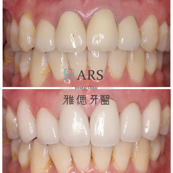 【全瓷冠】 案例6 –蔡昀蓉醫師