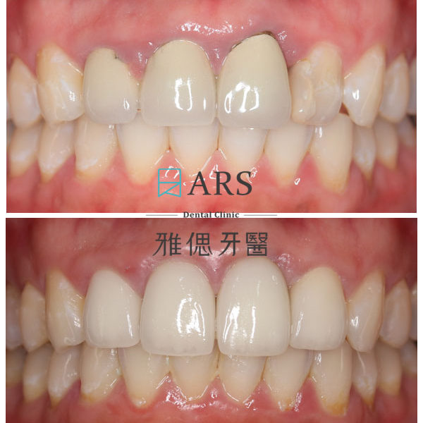 【全瓷冠】 案例7 –蔡昀蓉醫師