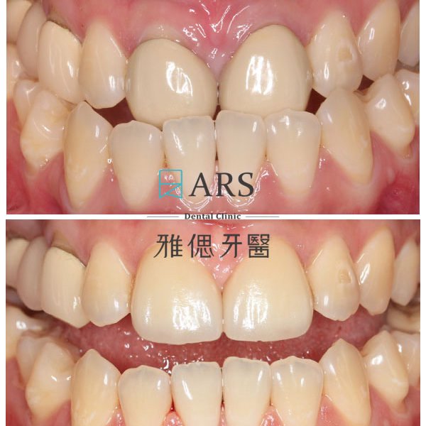 【全瓷冠】 案例8 –蔡昀蓉醫師