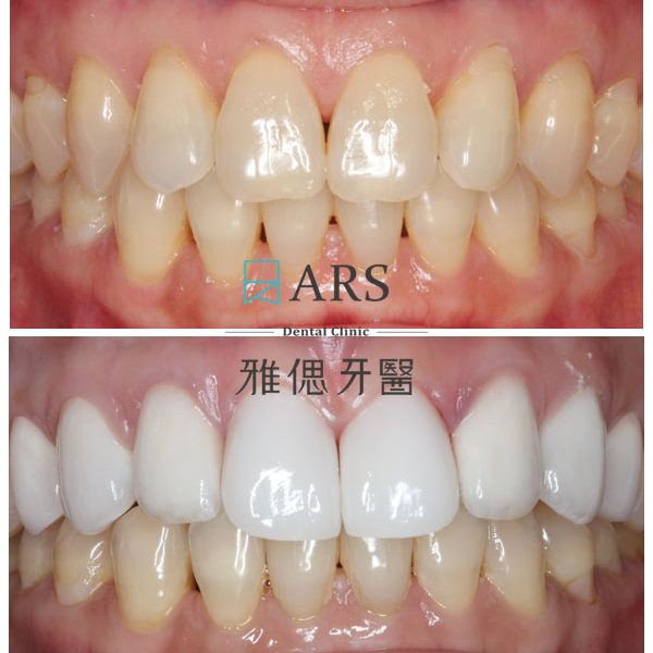 【全瓷冠】 案例9 –蔡昀蓉醫師