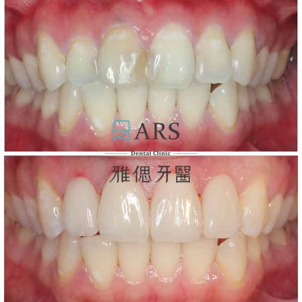 【全瓷冠+水雷射牙冠增長術】 案例1 – 蔡昀蓉 醫師