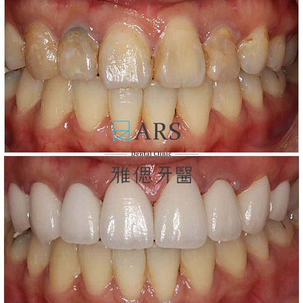 【全瓷冠+水雷射牙冠增長術】 案例1 – 鄭聖達醫師