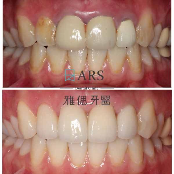 【全瓷冠+水雷射牙冠增長術】 案例1 – 鄭聖達醫師、蔡昀蓉醫師聯合主治
