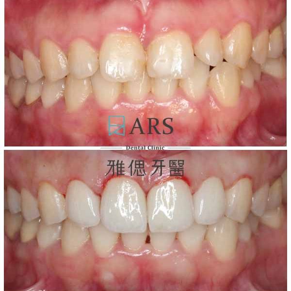 【全瓷冠+水雷射牙冠增長術】 案例2 – 蔡昀蓉醫師