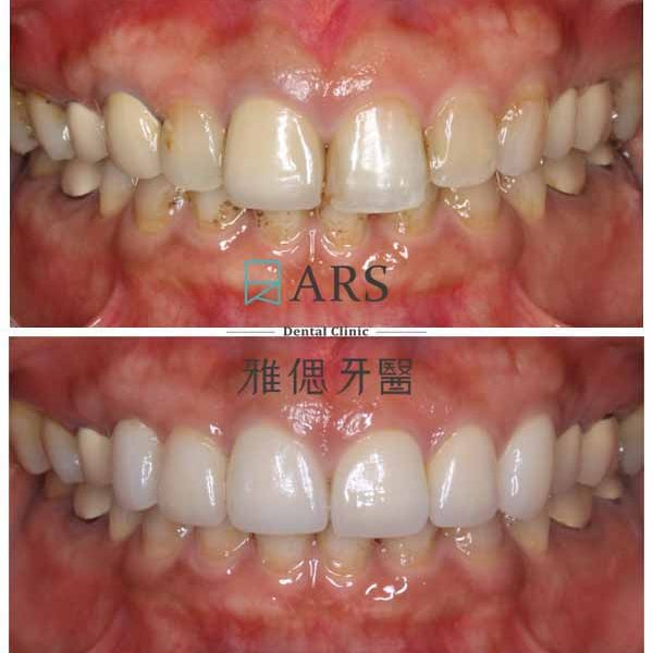 【全瓷冠+水雷射牙冠增長術】 案例2 – 鄭聖達醫師