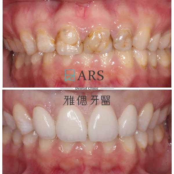 【全瓷冠+水雷射牙冠增長術】 案例2 – 鄭聖達醫師、蔡昀蓉醫師聯合主治-1