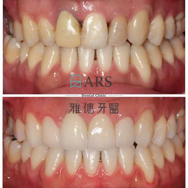 【全瓷冠+水雷射牙冠增長術】 案例3 – 鄭聖達醫師、蔡昀蓉醫師聯合主治