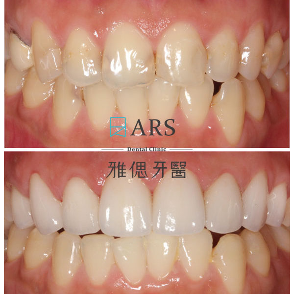【全瓷冠+陶瓷貼片】 案例10 – 蔡昀蓉醫師