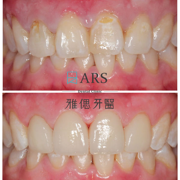 【全瓷冠+陶瓷貼片】 案例10 – 鄭聖達醫師