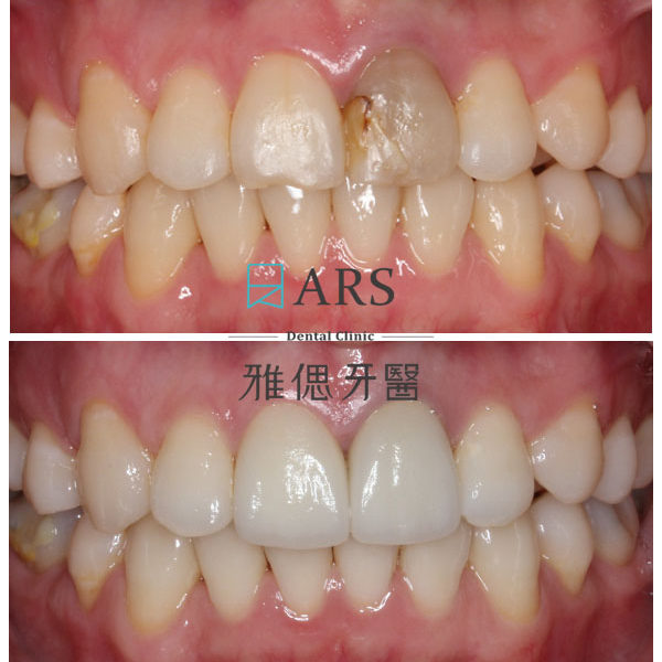 【全瓷冠+陶瓷貼片】 案例11 – 蔡昀蓉醫師