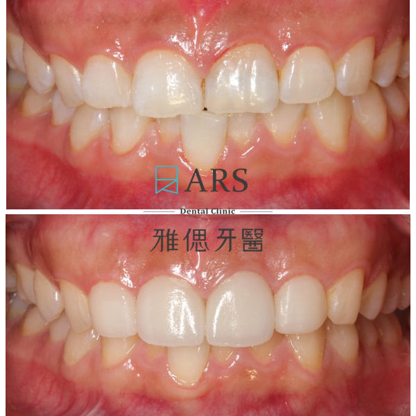 【全瓷冠+陶瓷貼片】 案例13 – 蔡昀蓉醫師