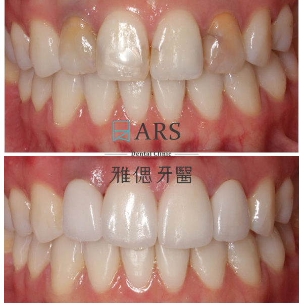 【全瓷冠+陶瓷貼片】 案例14 – 蔡昀蓉醫師