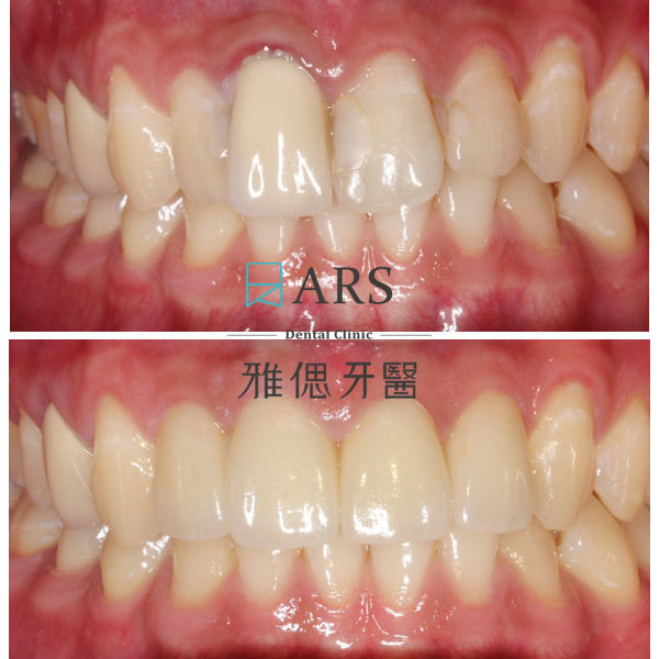 【全瓷冠+陶瓷貼片】 案例3 – 蔡昀蓉醫師