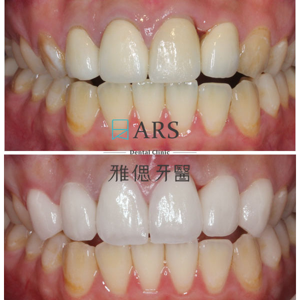 【全瓷冠+陶瓷貼片】 案例4 – 蔡昀蓉醫師